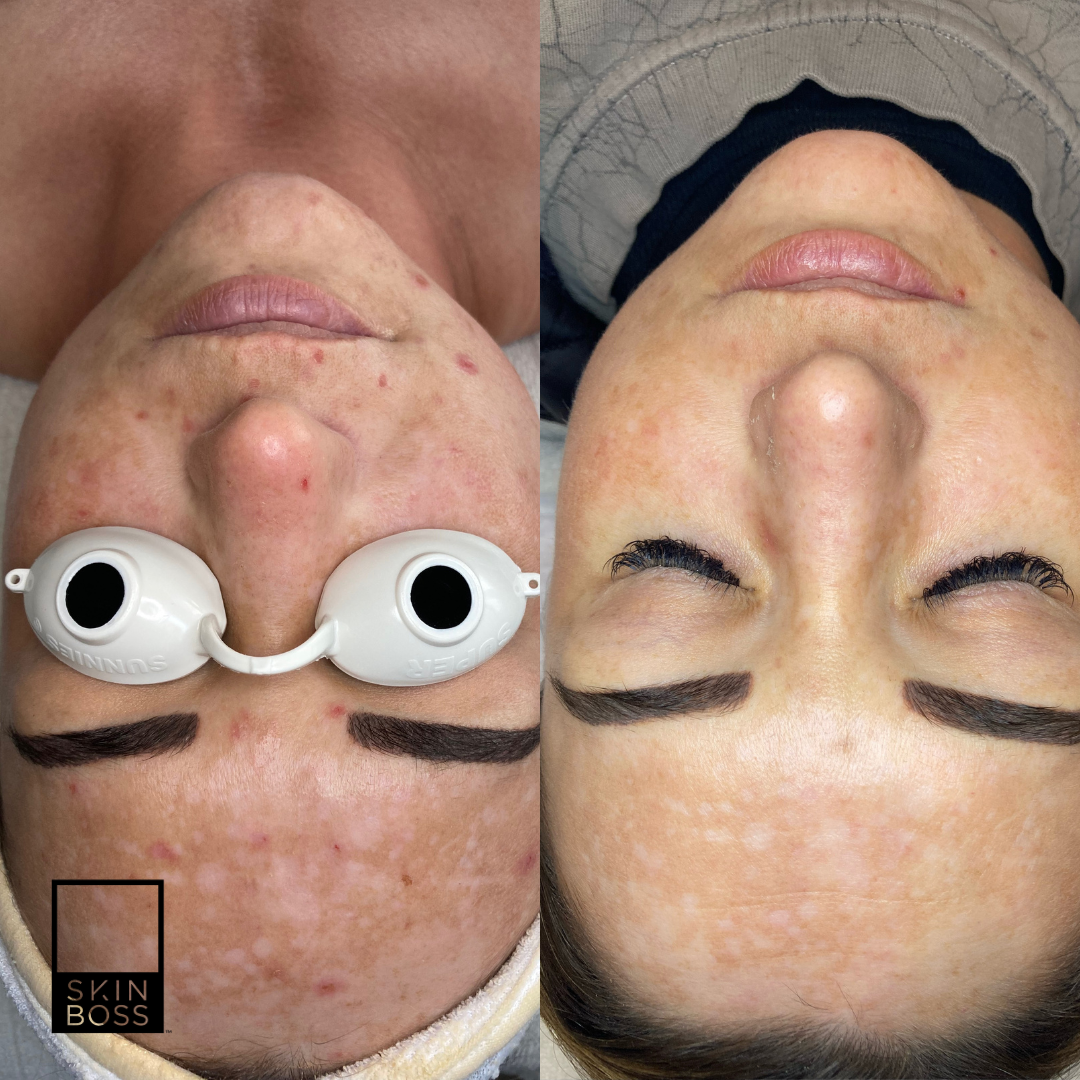 before and after hyperpigmentation results. Redness relief  for a more even skin tone.